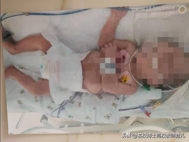 小宝早产在医院一个月母乳不够,早产宝宝病危通知