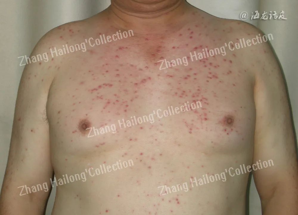 前胸后背长痘是马拉色菌感染吗,胸背部毛囊炎疙瘩大小不一样