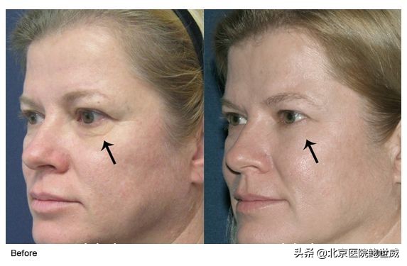 了解抗衰老护肤品,热玛吉抗衰2019