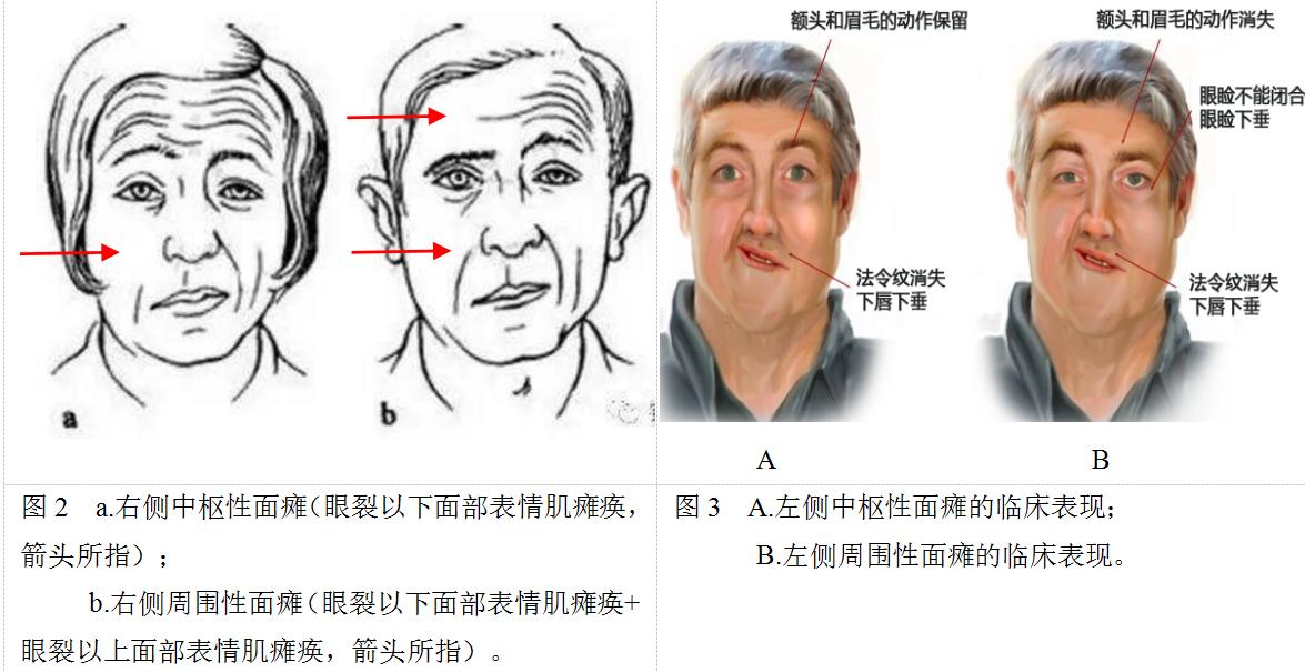 中风面瘫嘴歪眼斜怎么治疗,嘴歪眼斜是面瘫吗怎么治