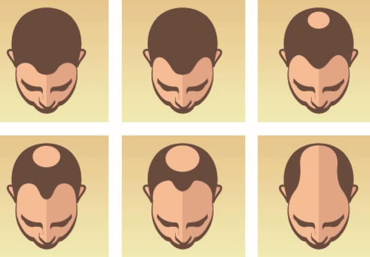 雄激素性脱发是一种病吗,雄激素性脱发什么造成的