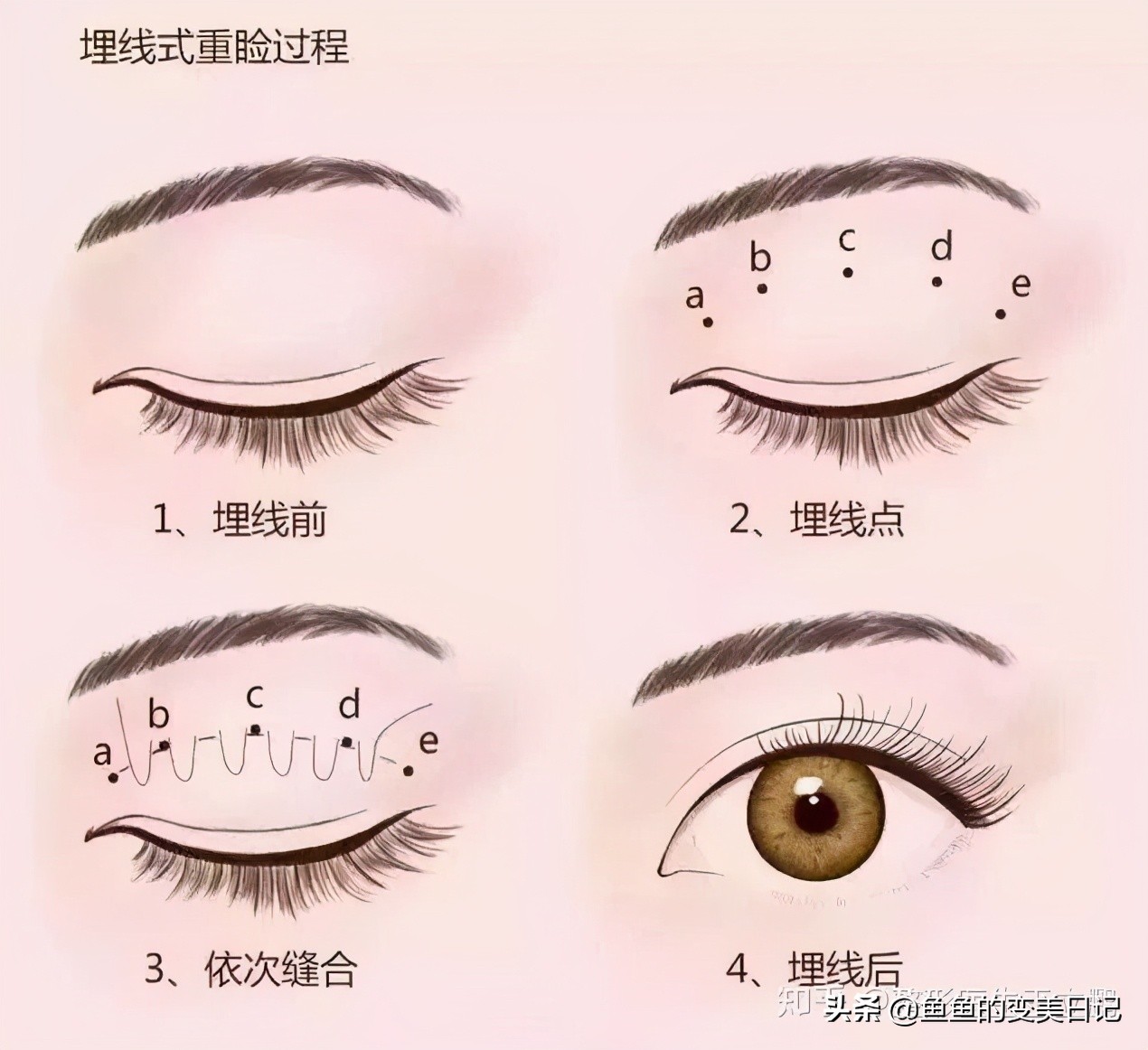 双眼皮知识点总结大全,关于双眼皮的十大真相