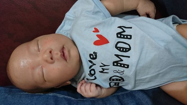 新生儿脂溢性皮炎怎么治疗最彻底,新生儿脂溢性皮炎用什么护理