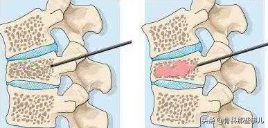 老人摔小腿骨折要手术吗,老年人腰椎压缩性骨折需住院多久