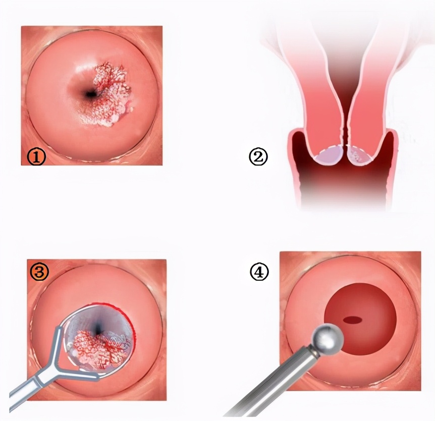 TCT、阴道镜、CIN、锥切（leep）都是什么意思？