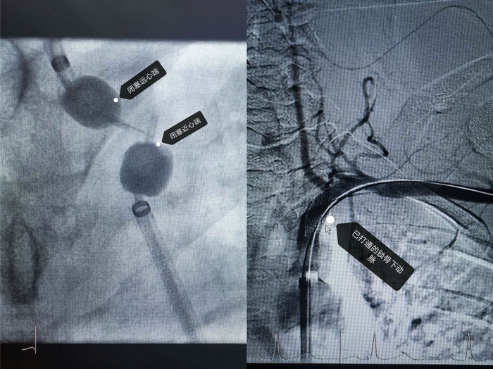 手臂动脉闭塞多久有症状,手腕动脉闭塞怎么治疗