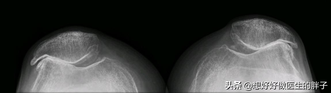 髌骨软骨损伤膝盖总是咔咔响,膝盖损伤后髌骨响是什么原因