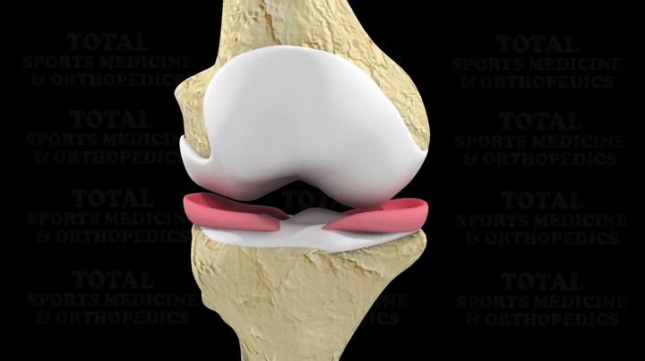 为什么足球运动员不会半月板受伤,半月板伤病对足球运动员影响大吗