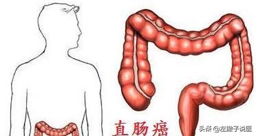 体重突然下降15斤，一查竟然是肠癌，这是为什么？一文为你解答
