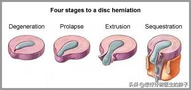 腰椎间盘突出核掉椎管里怎么治疗,腰椎间盘髓核掉进椎管严重吗