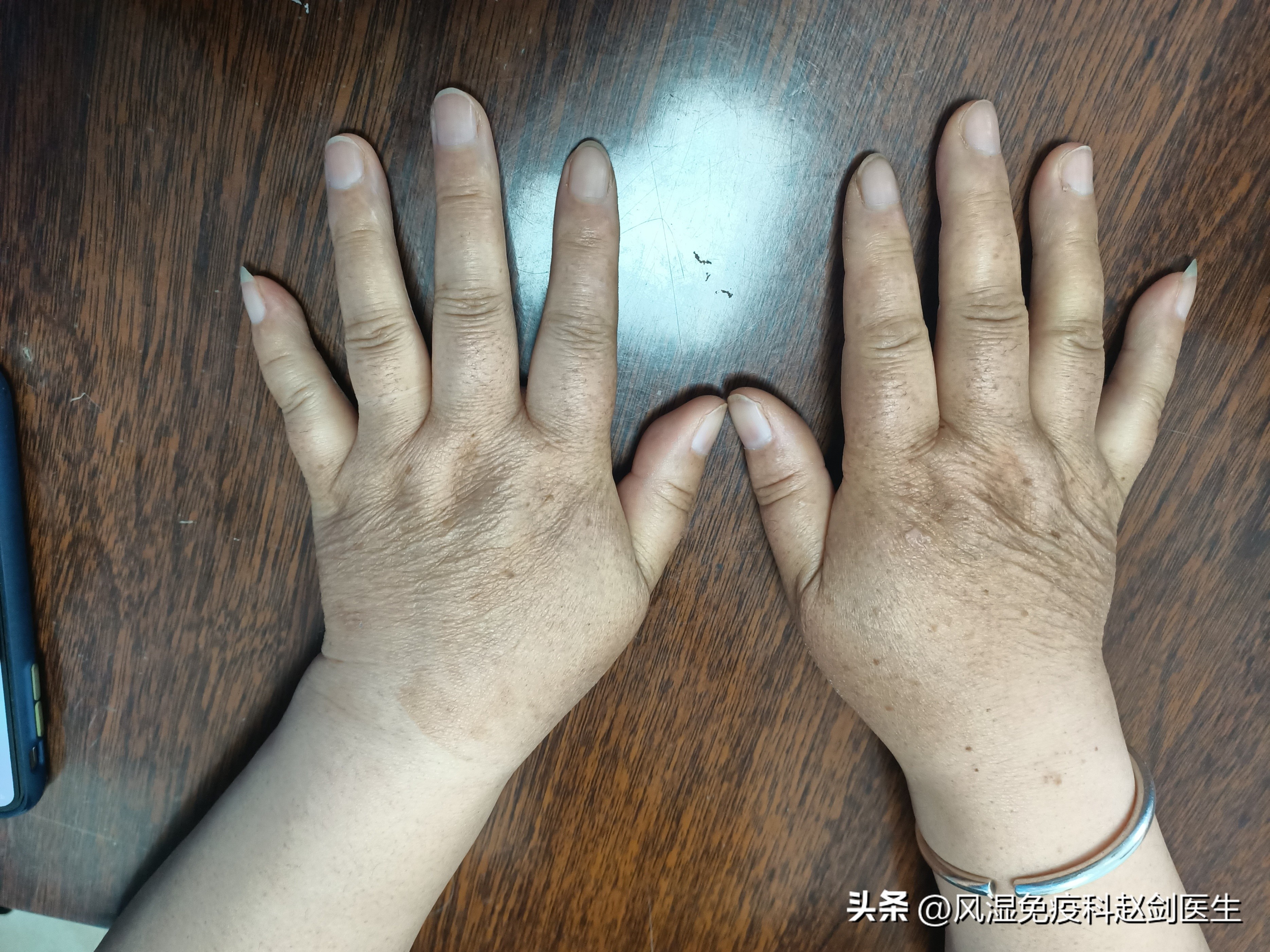 类风湿性关节炎用什么激素好,类风湿关节炎必须用活血药吗