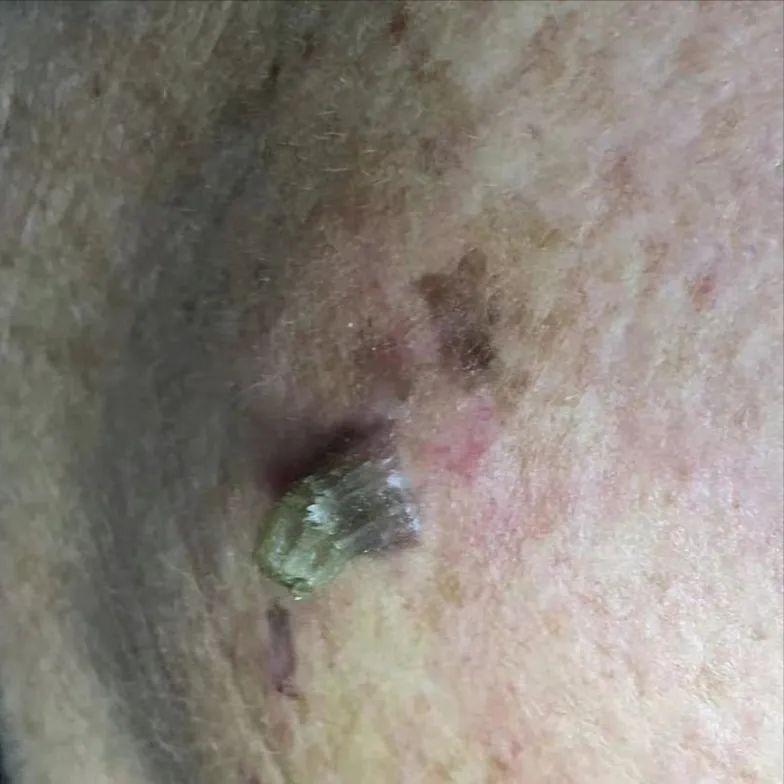 脸上长硬硬的小鼓包,脸上长小米粒疙瘩怎么办