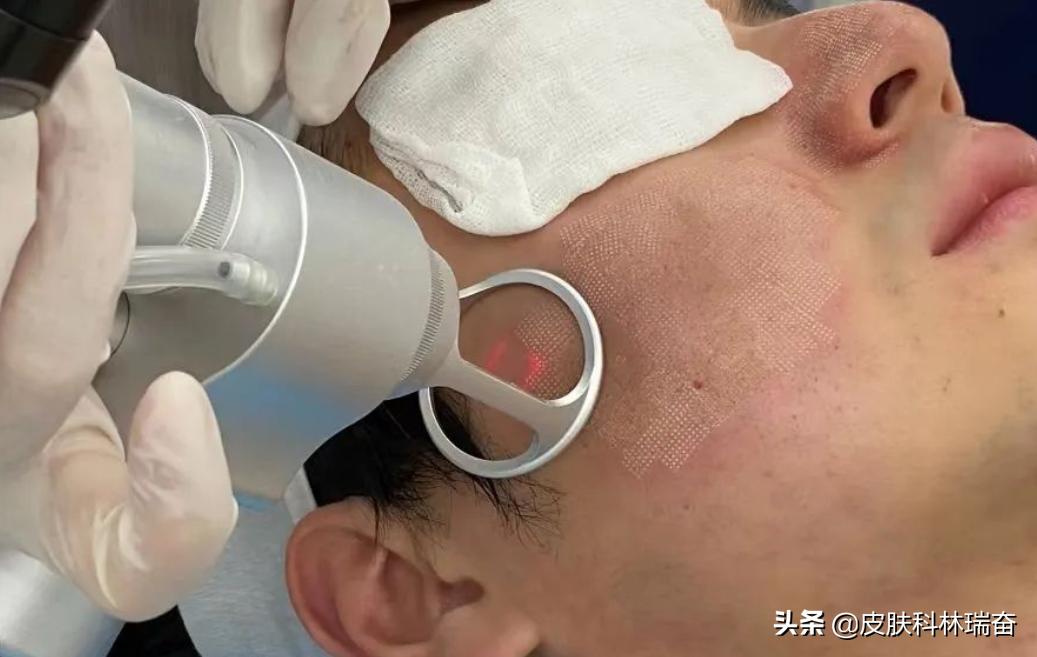 痘坑剥离激光点阵后长痘痘,脸上痘坑点阵激光治疗后效果图片