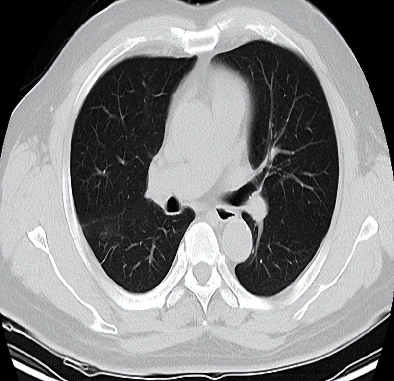 海南首例恶性胸膜间皮瘤,胸膜间皮瘤生存5年算治愈吗