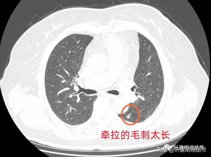 肺结节实性为什么建议抗炎治疗,肺上实性结节抗炎后变成空洞