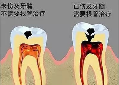 牙晚上疼白天不疼要看牙科吗,牙齿本来不疼去看了牙医后就疼了