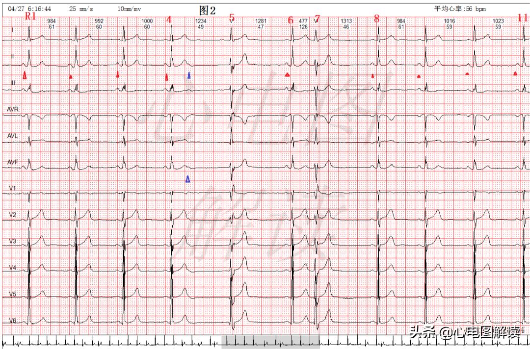 室性并行心律可能有间位性的吗,加速的室性逸搏心律的心电图表现