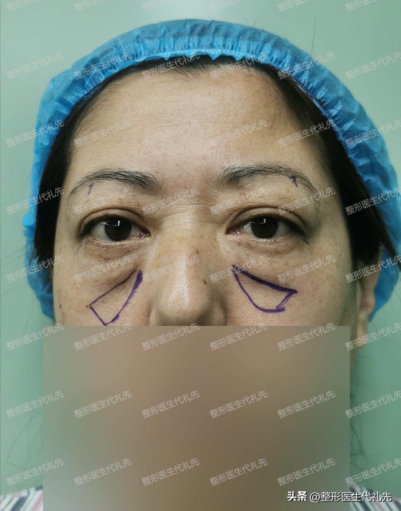 眼袋手术后出现皱纹和凹陷怎么办,祛眼袋手术后凹陷多久恢复好