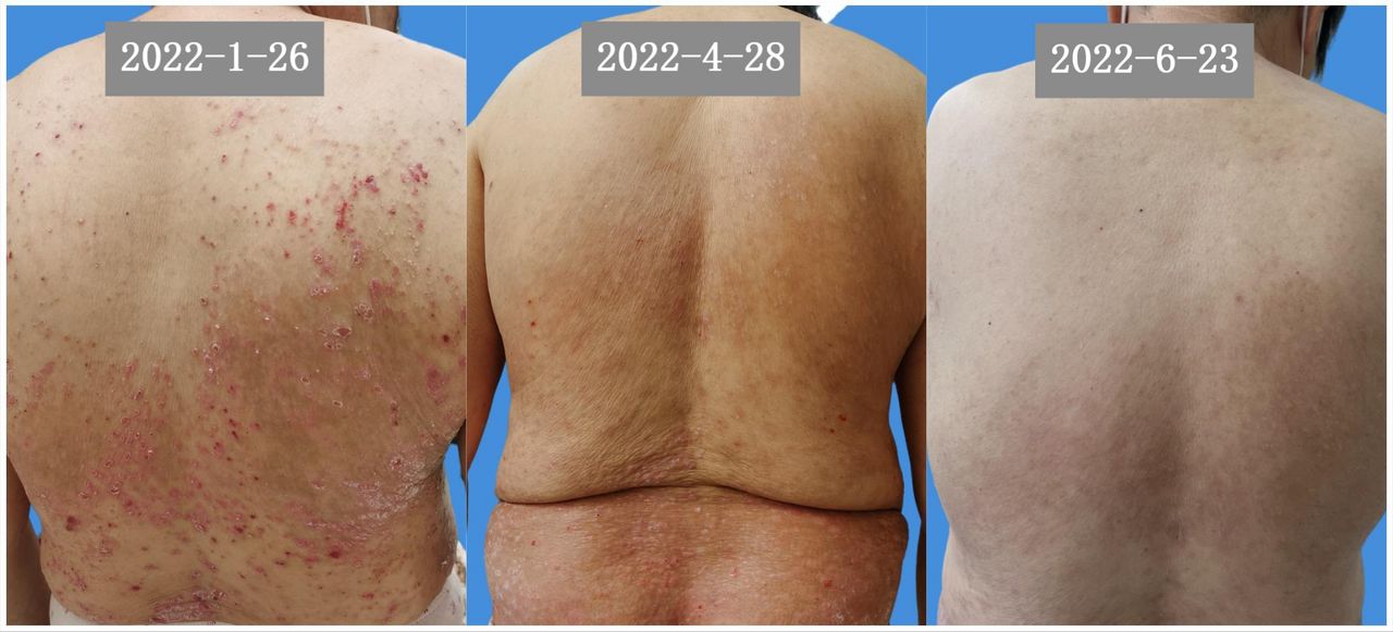 白介素23抑制剂治疗斑块状银屑病,治疗斑块型银屑病最好的方法