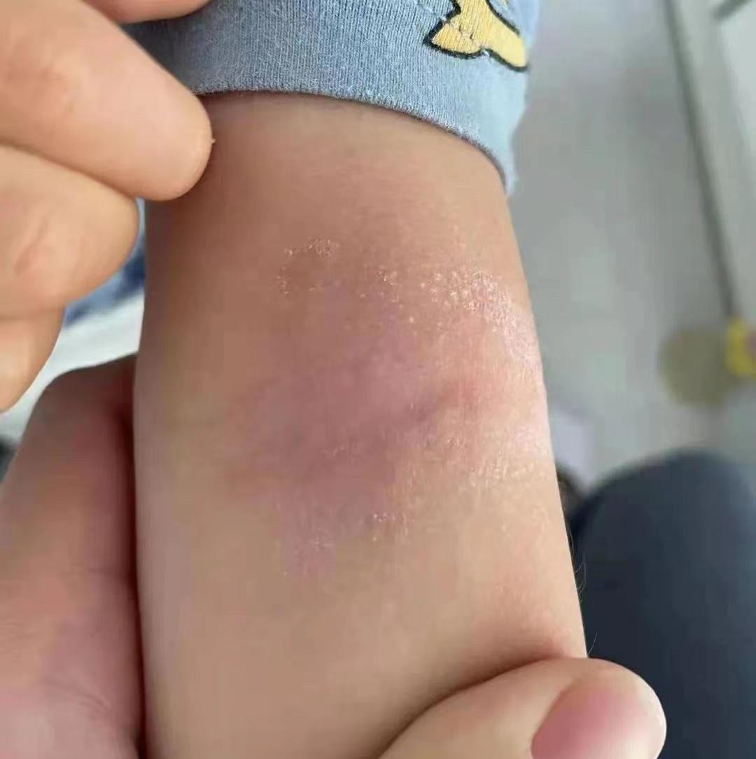 宝宝湿疹不断复发怎么办,小孩儿湿疹反复复发怎么办