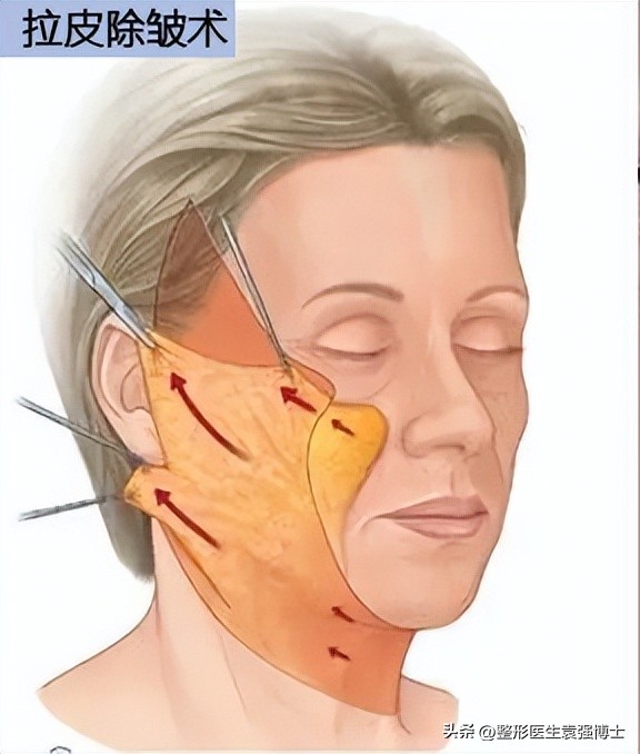 拉皮手术后的疤痕图片,耳前切口拉皮疤痕图片
