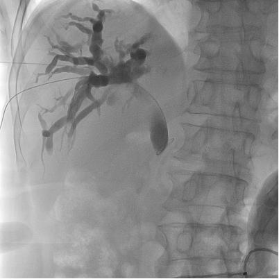 介入穿刺全过程,介入穿刺技术