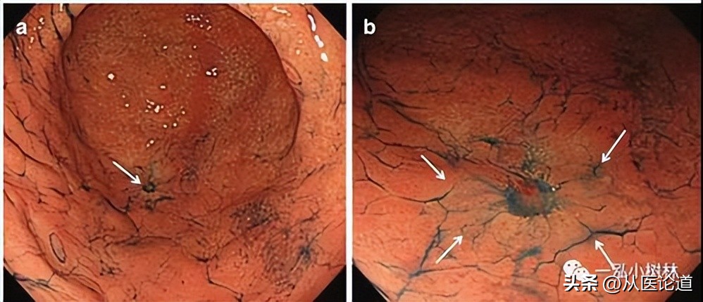 胃癌转移淋巴哪个部位,胃癌侵犯浆膜淋巴转移