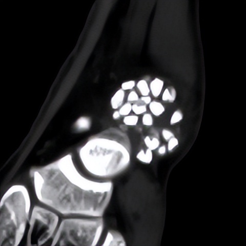 脚踝扭伤的处理方法和注意事项,轻度脚踝扭伤的处理方法及康复