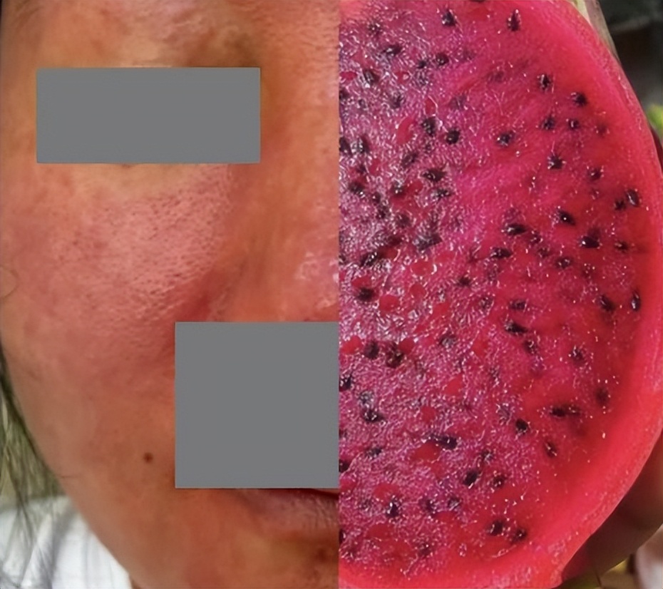 杭州女子养仓鼠脸烂成火,杭州一女子养仓鼠脸竟烂成火龙果