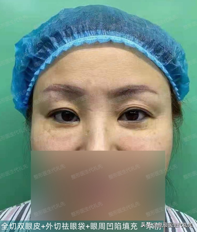 55岁女人割双眼皮之后的视频,40多岁女人做完双眼皮的视频