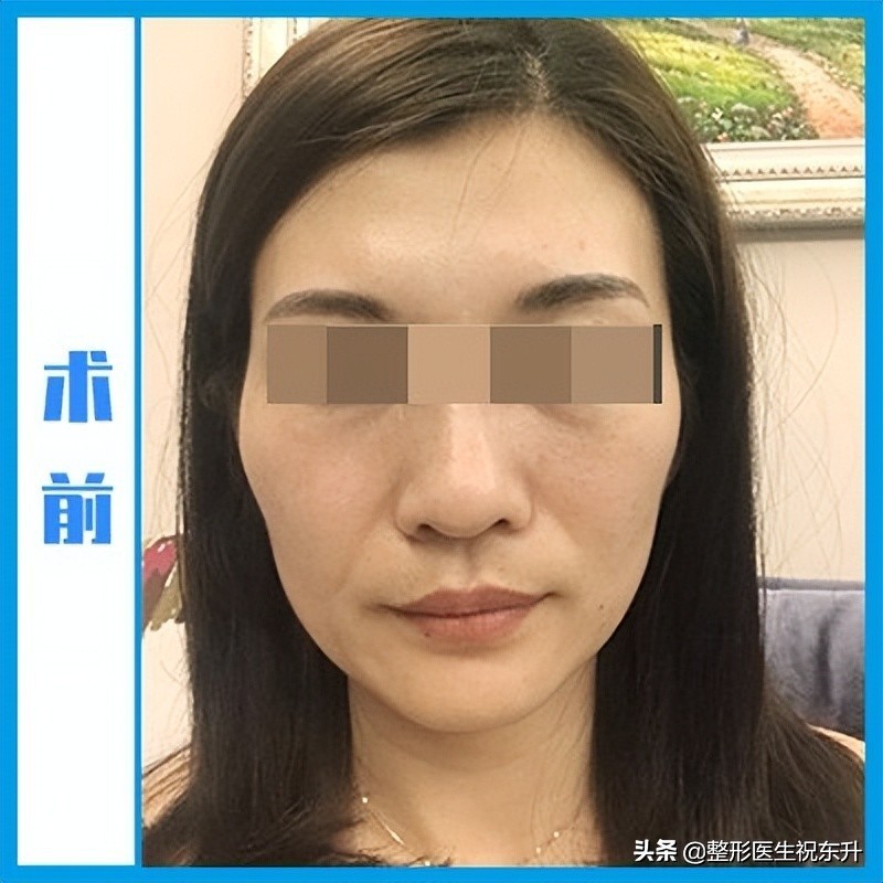 面诊后拉皮除皱,小切口拉皮手术后第一天记录一下