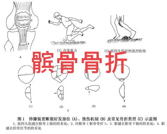 髌骨骨折的临床症状有哪些,髌骨骨折病因及发病机制