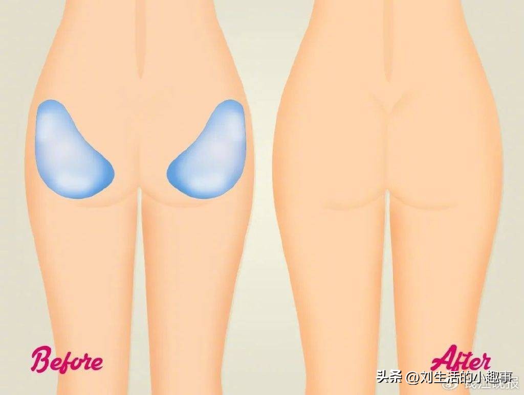 网红丰臀手术死亡,隆臀手术死亡的女子