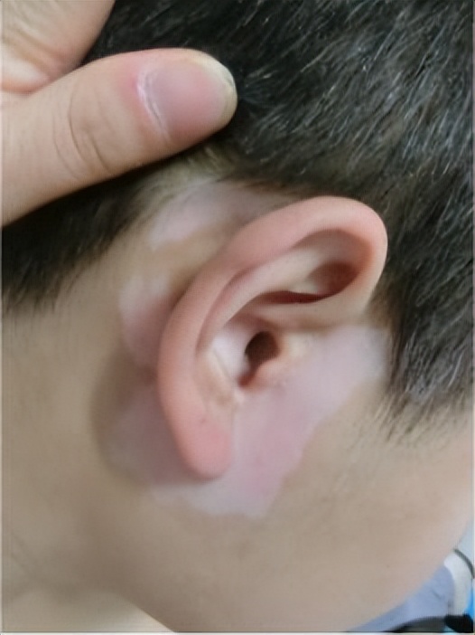 白癜风治愈的最佳方法,白癜风做308分子激光能彻底治愈吗