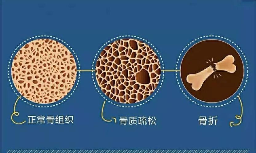 80多老年人骨质疏松骨折怎么治疗,老年人摔了一跤腿大筋疼