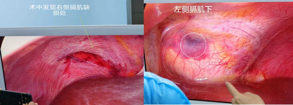 麻醉期间气道梗阻,手术后呼吸急促是什么原因