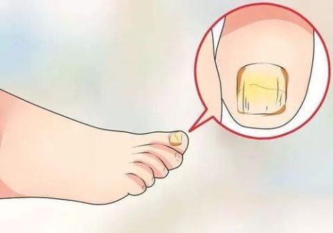 脚趾甲变厚变黄挂什么科,脚趾甲有问题去医院看什么科