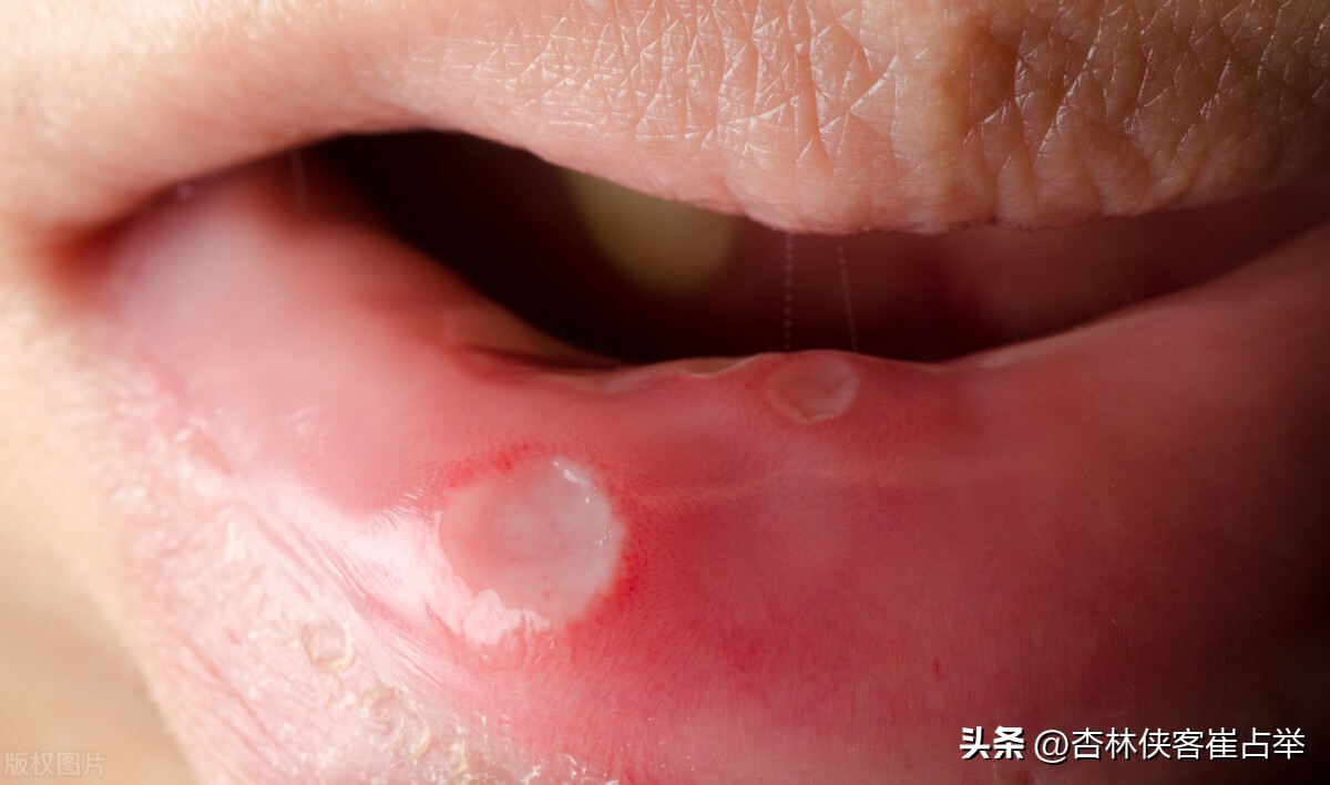 心火胃火肝火肺火吃什么中成药,治肝火胃火肺火心火肾火的中成药