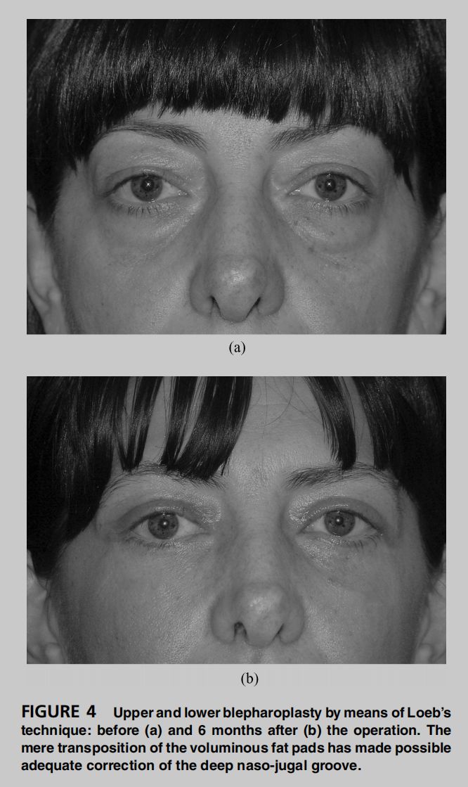 印第安纹解剖学,印第安纹分型对策