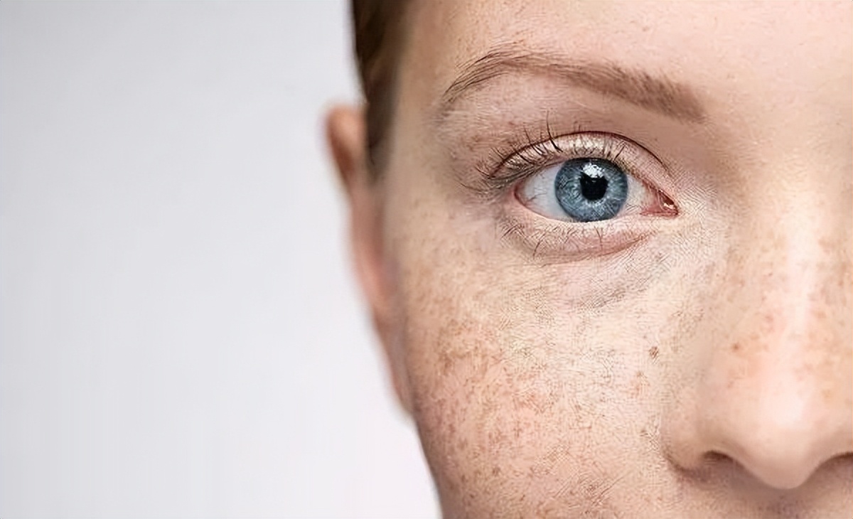 为什么有人没老年斑皮肤白,为什么40多岁就满脸老年斑