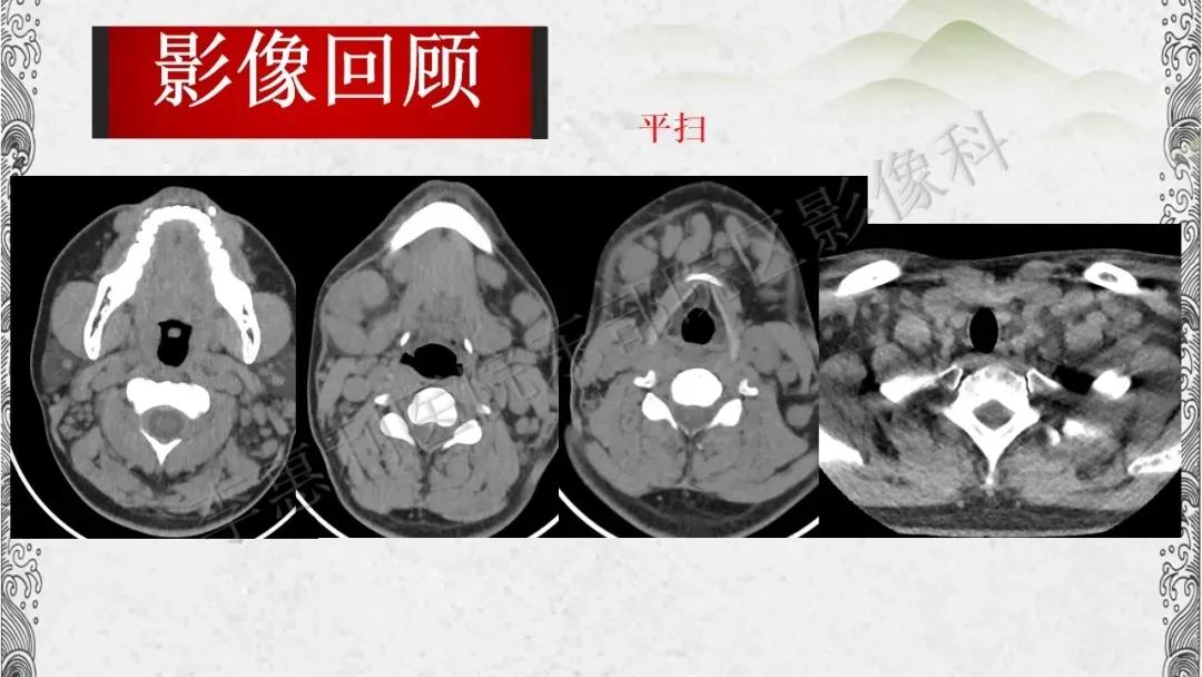 木村病治愈成功案例,木村病诊断案例