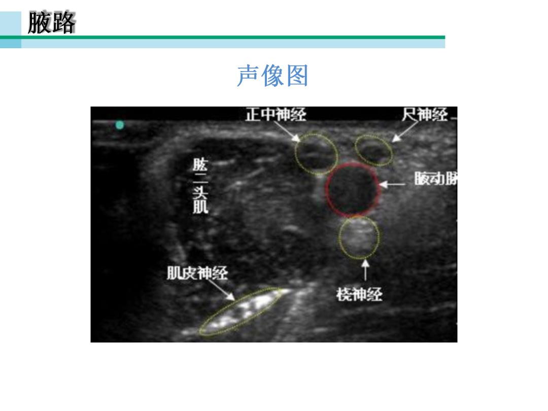 超声引导下臂丛神经阻滞,PPT课件