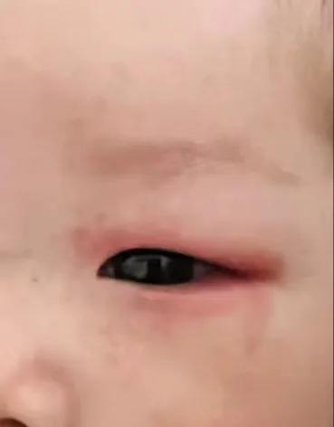 吃了退烧药过敏起皮疹严重吗,吃退烧药过敏还能吃吗