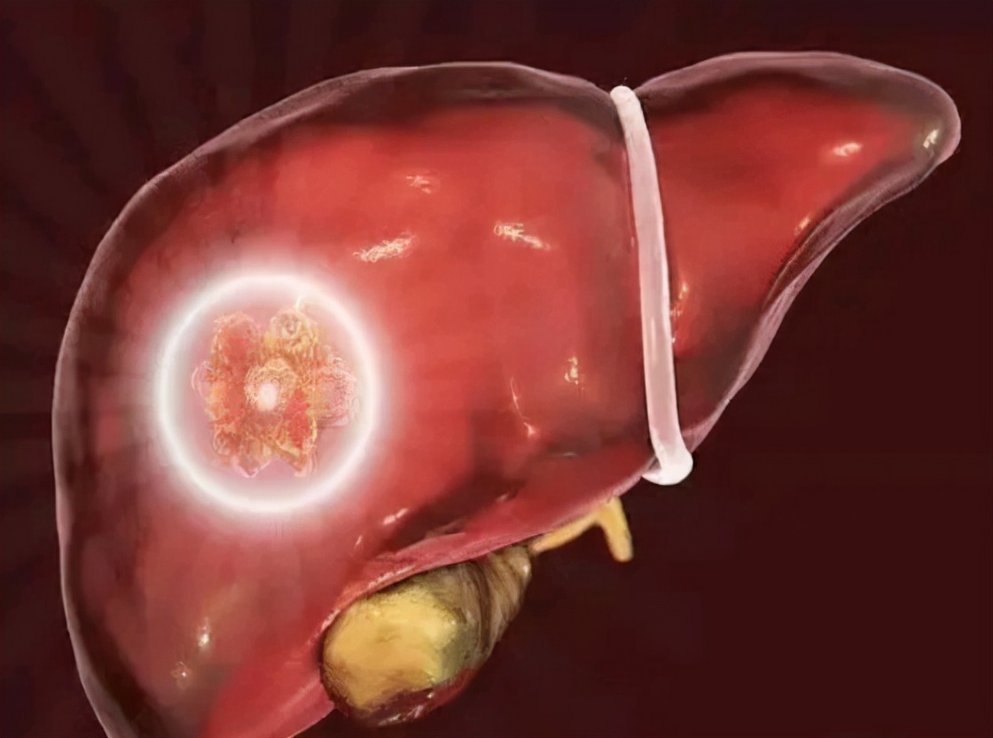 肝硬化身上长小红点痒是什么征兆,肝硬化脚面出了好多小红点有点肿