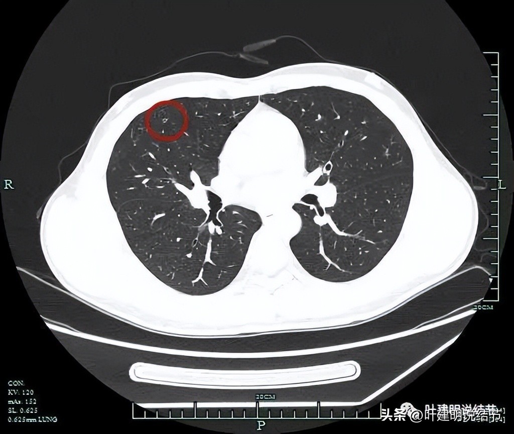 中叶多发微小结节,男性30岁右侧甲状腺单发结节