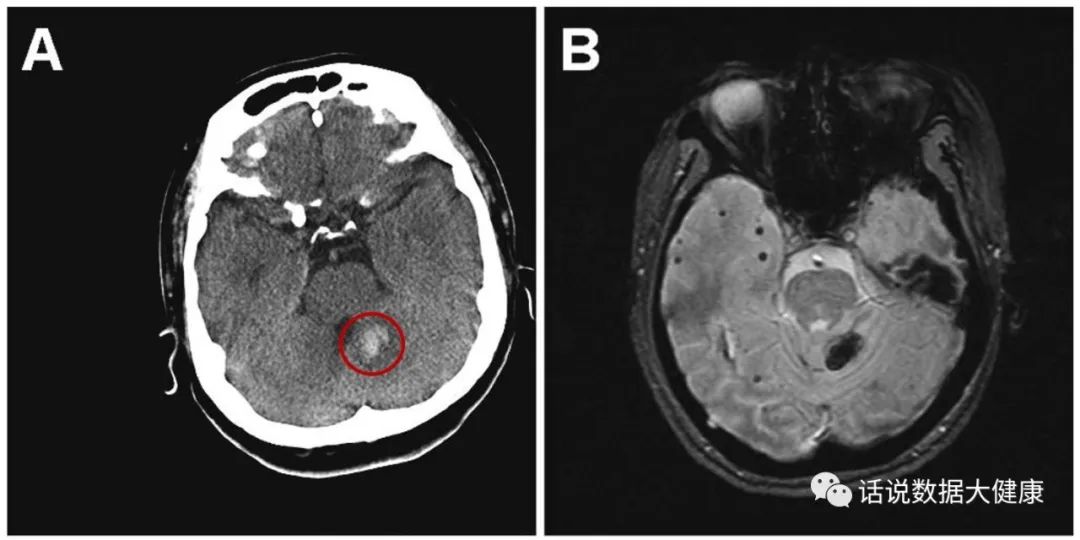 纳豆能预防心脑血管病吗,纳豆胶囊对于心血管狭窄有效吗