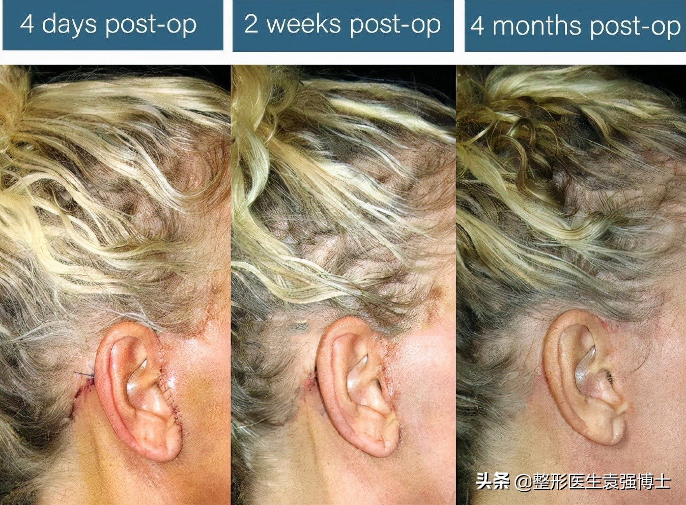 拉皮手术后的恢复过程,你知道拉皮术后要注意什么吗