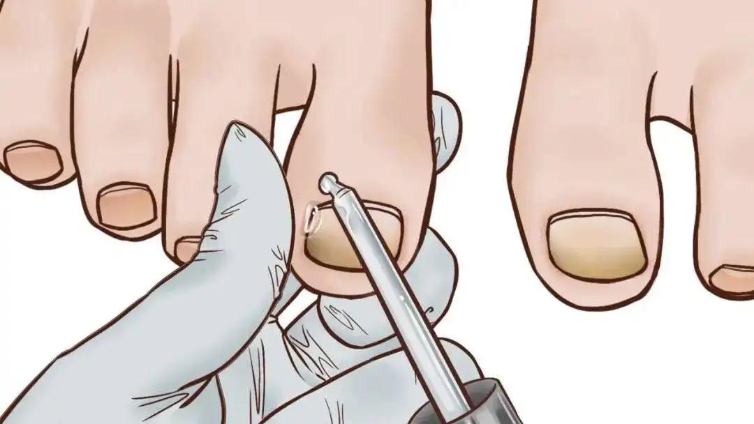 脚趾甲老往肉里钻，一碰还疼？教你小妙招，预防甲沟炎告别疼痛