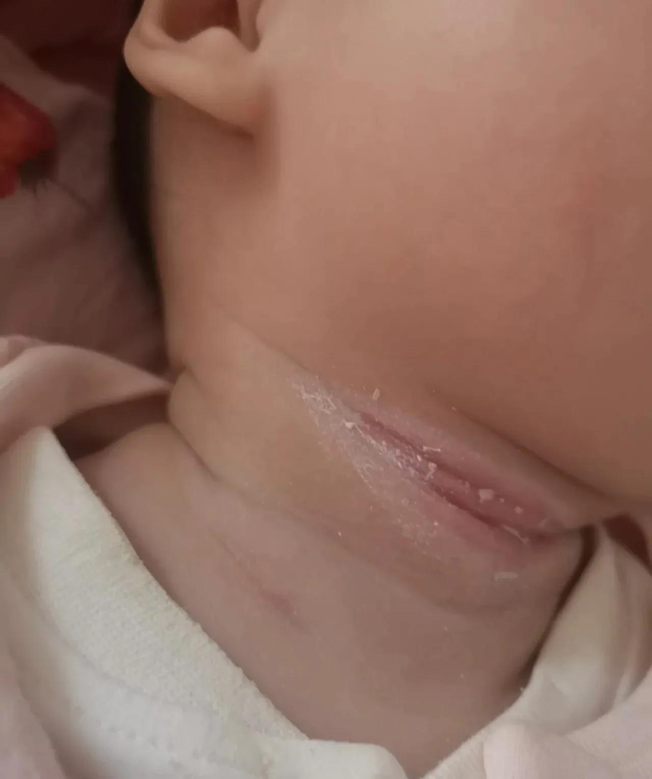 新生儿淹脖子发红怎么处理,宝宝淹脖子泛红涂什么最好