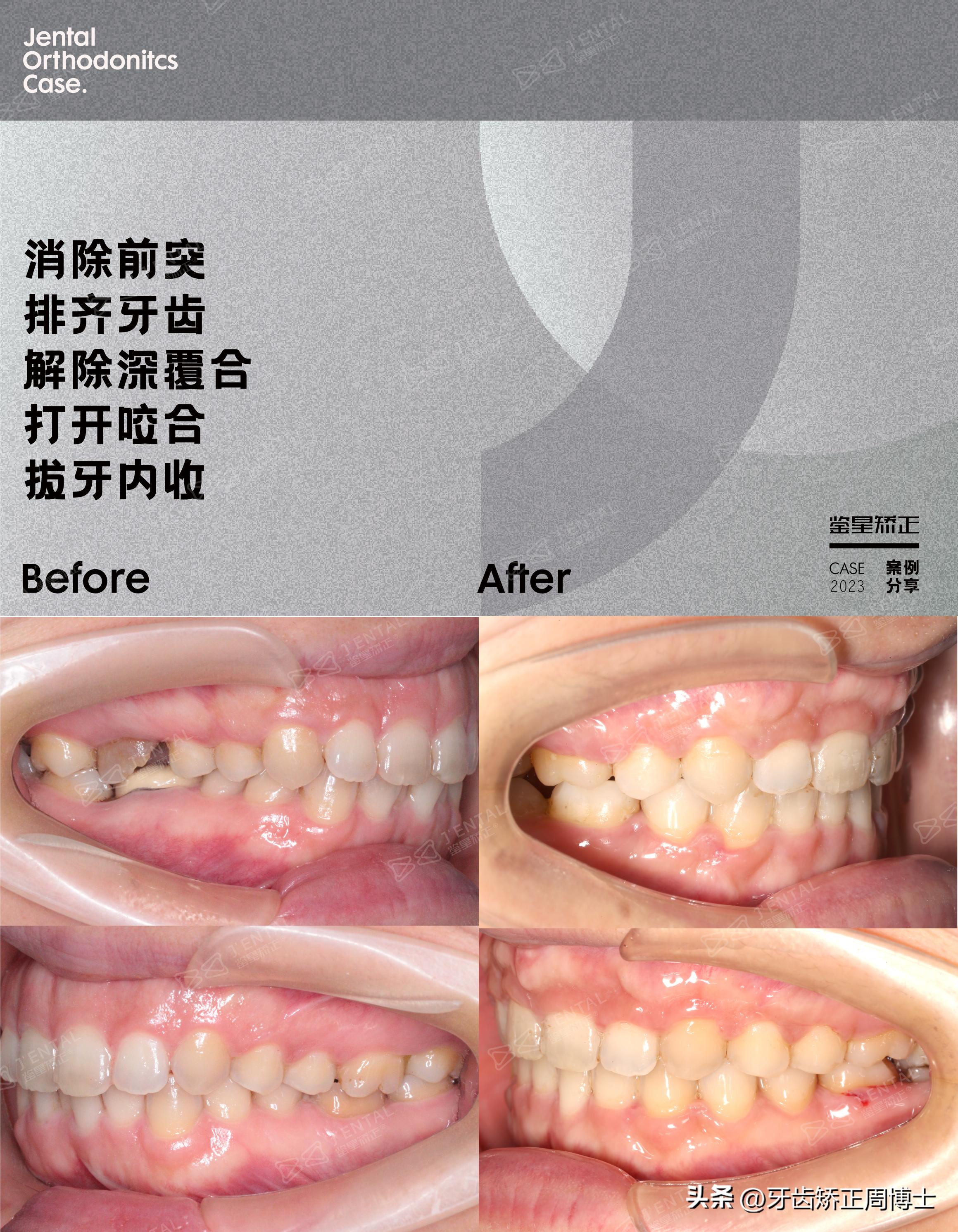 骨性龅牙怎么通过普通的矫正改善,骨钉如何解决骨性龅牙